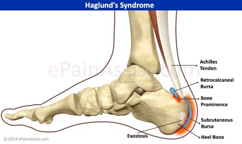 Haglund's deformity is a bony enlargement on the back of the heel. 허글런드 변형(Haglund deformity) : 운동을 하면 발꿈치 뒤가 아프고 쉬면 좋아지지만 다시 ...