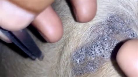 Clusters Of Blackheads Super Blackheads And Spreading Black Heads Youtube
