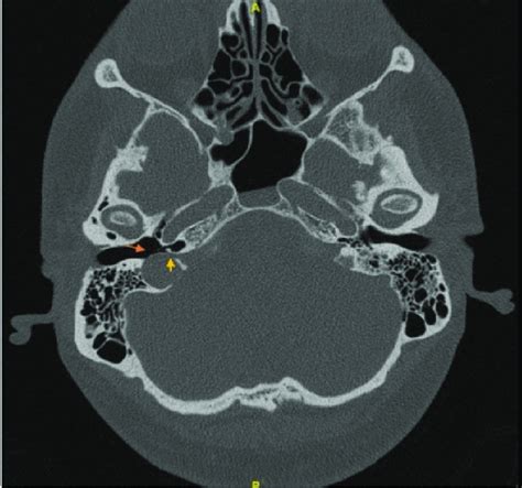 High Resolution Ct Scan Of The Temporal Bone In Axial Plane Obtained