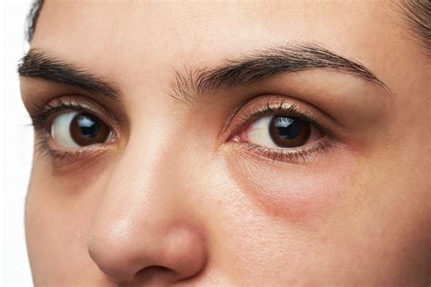 Banish Under Eye Bags With Fraxel Ultimate Image Cosmetic Medical Center