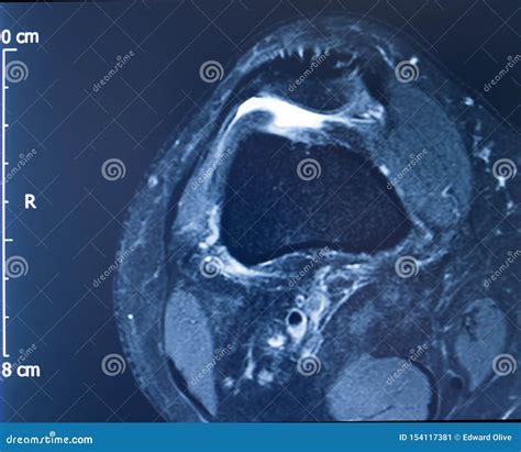 Knee Injury Mri Mcl Tear Stock Image Image Of Health 154117381