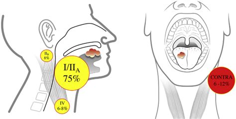 Predominant Lymph Node Levels For Metastasis Of Tongue Scc Lindberg