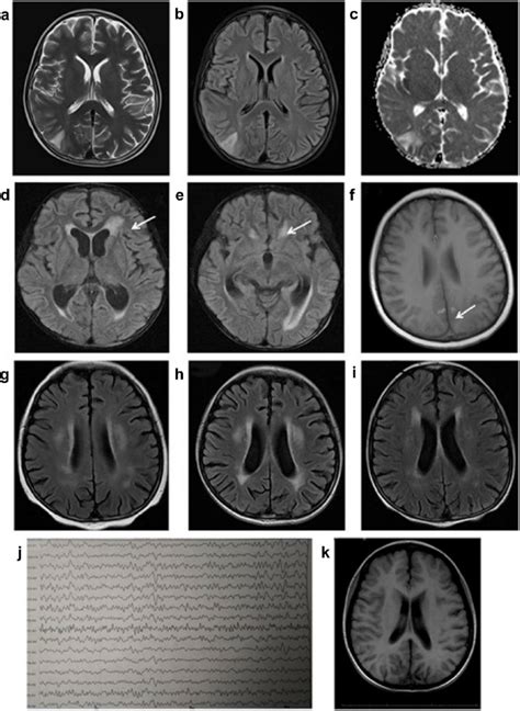 Brain Magnetic Resonance Imaging Mri And Electroencephalography A Download Scientific