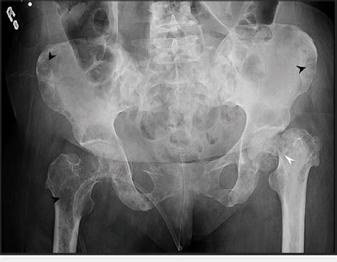Plain X Ray Of The Pelvis Showing Multiple Innumerable Lytic Lesions