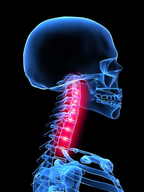What Is Cervical Myofascitis Info From An Injury Doctor