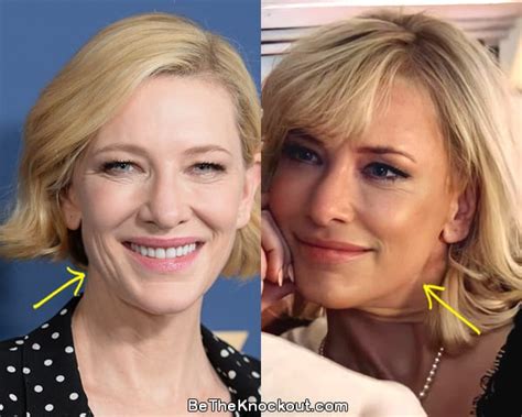 Cate Blanchett Plastic Surgery Comparison Photos