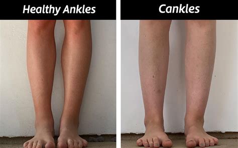Causes And How To Get Rid Of Cankles With Exercise And Surgery 052023