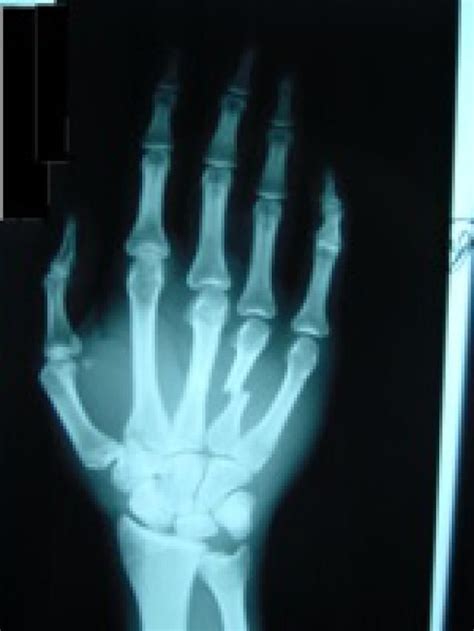 What You Need To Know About Metacarpal Fracture Broken Hand Hand