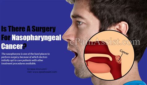 Is There A Surgery For Nasopharyngeal Cancer