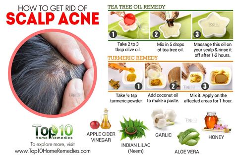 Scalp Acne New Rev 1000×667 Scalp Acne Cystic Acne Remedies