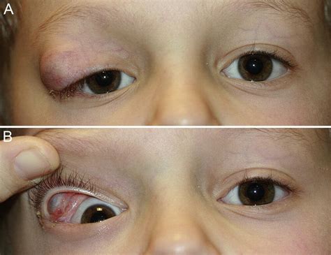 Developmental Conjunctival Cyst Of The Eyelid In A Child Journal Of