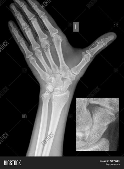 Hand Wrist X Ray Scaphoid Fracture Image And Photo Bigstock