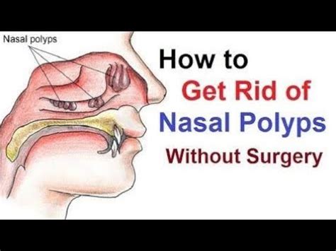 Small nasal polyps may not cause symptoms. Nasal polyps _ symptoms & medicine! Homeopathic medicine ...