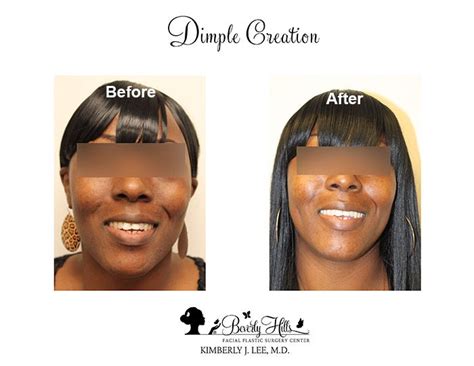 Dimple Creation Patient Gallery Facial Plastic Surgery Facial