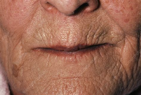 Elderly Womans Lips Purple Due To Cyanosis Stock Image M1300227