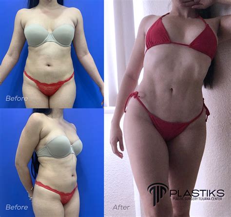 Plastic Surgery Tijuana Center - Home