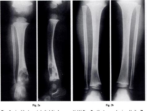 Figure 2 From Cystic Tuberculosis Of Bone In Children Semantic Scholar