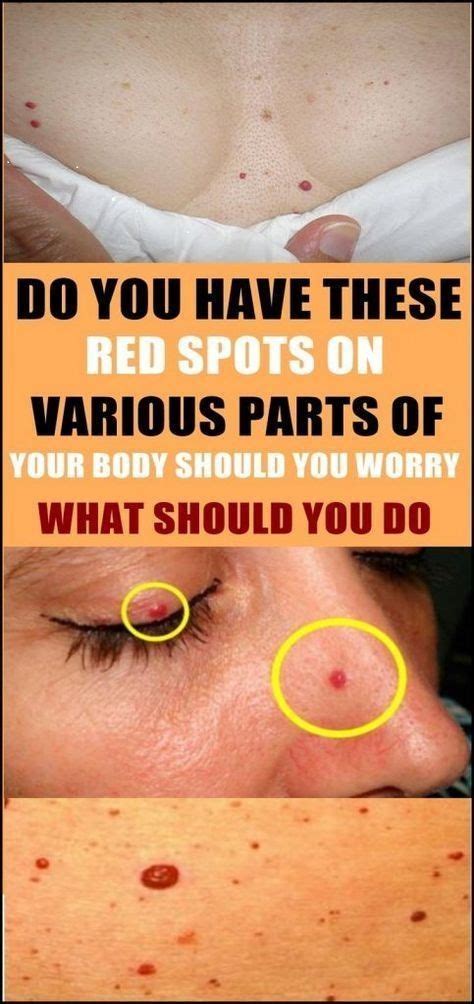 Do You Have These Red Spots On Various Parts Of Your Body Red Spots
