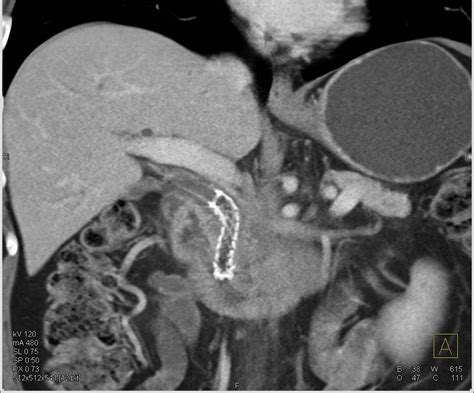 Stent In Common Bile Duct In Patient With Pancreatic Cancer Pancreas