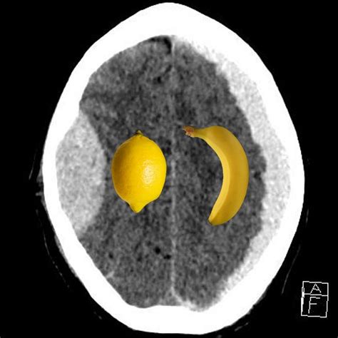 Jul 22, 2021 · x external fixation has been widely used as an initial surgical option for periarticular fractures, articular dislocation, and long bone fractures. Subarachnoid Vs Subdural Haemorrhage - maternity photos