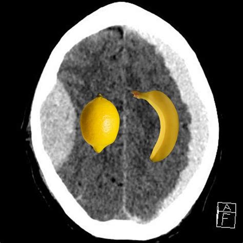 Who is most likely to develop a subdural hematoma? Subarachnoid Vs Subdural Haemorrhage - maternity photos