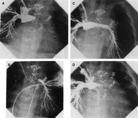 Transcatheter Reconstruction Using Intravascular Stents Of Acquired