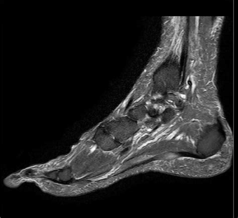 The plantar muscles of the foot are much more substantial than the thin dorsal muscles of the foot. Plantar fasciitis-MRI - Sumer's Radiology Blog