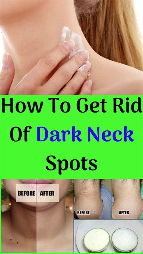 How to reduce and prevent necklines Home Remedies To Get Rid Of Dark Neck Spots in 2020 | Best ...