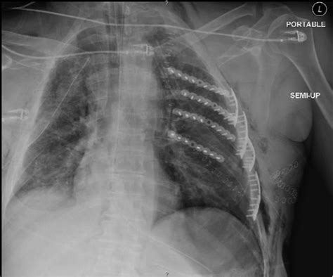 Blunt Rupture Of The Thoracic Duct After Severe Thoracic Trauma
