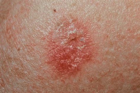 Skin Cancer Rash On Back