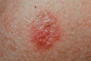 pics of skin cancers - pictures, photos Skin Cancer  