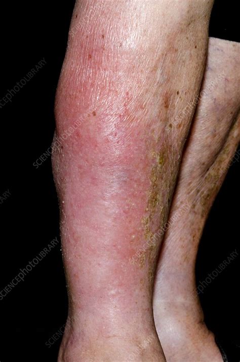 Cellulitis On The Leg Stock Image C0155929 Science Photo Library