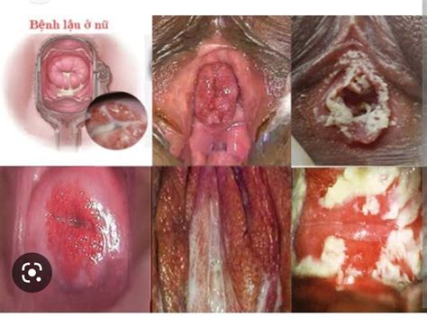 Symptoms Of Symptoms Of Gonorrhea Hot Sex Picture