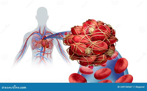 Pulmonary Embolism Illness Stock Illustration Illustration Of Heart