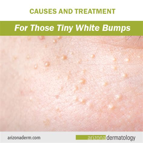 Milia Causes And Treatment For Those Tiny White Bumps