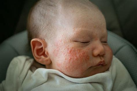 Mi BebÉ Tiene Granitos Blancos En La Cara Causas Y Tratamiento