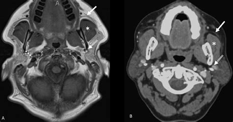 Imaging Of Salivary Gland Pathology Operative Techniques In