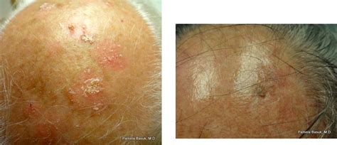 Actinic Keratoses Basuk Dermatology