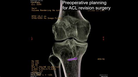 Preoperative Planning For Acl Revision Surgery Youtube