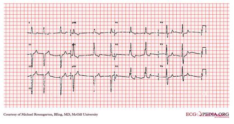 Przykłady EKG bloku prawej odnogi pęczka Hisa | Mefics