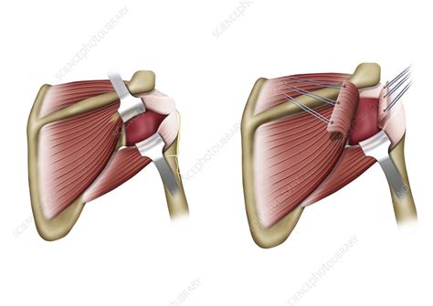 Shoulder Joint Capsule Surgery Illustration Stock Image C0473205