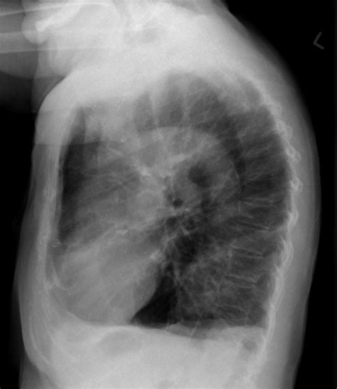Emphysema Undergraduate Diagnostic Imaging Fundamentals