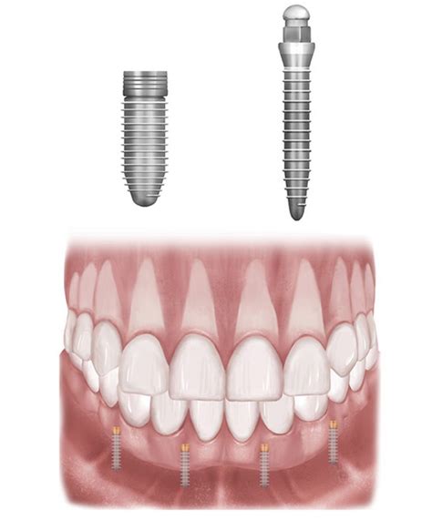 Mini Implants The Dental Implant Guide