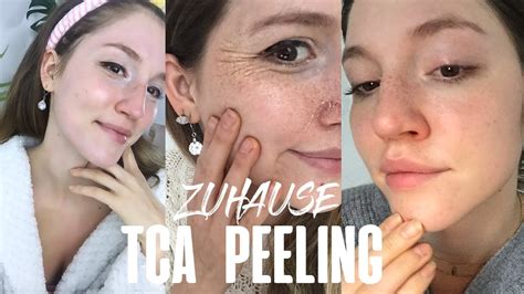 Anleitung Tca Peeling Für Zuhause Ein Neues Gesicht Youtube