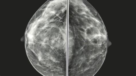 Mammogram Images Understanding Your Results