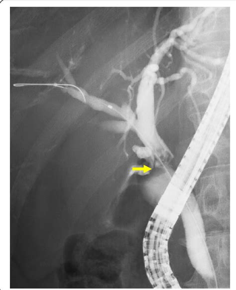 Endoscopic Retrograde Cholangiopancreatography Revealed Stenosis Of The