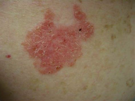 Diabetes Risk Increased In Those With Severe Psoriasis Toronto