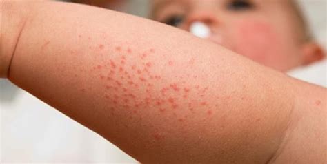 Lower Leg Rash What You Need To Know About A Rash On One Lower Leg