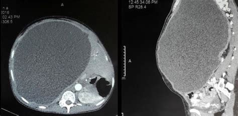 A Axial View And B Sagittal View Showing The Giant Hydatid Cyst With