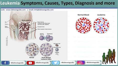 Leukemia Symptoms Causes Types Diagnoses And More Lab Tests Guide